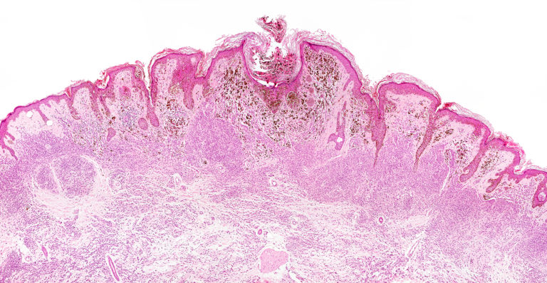 Malignant melanoma under the microscope