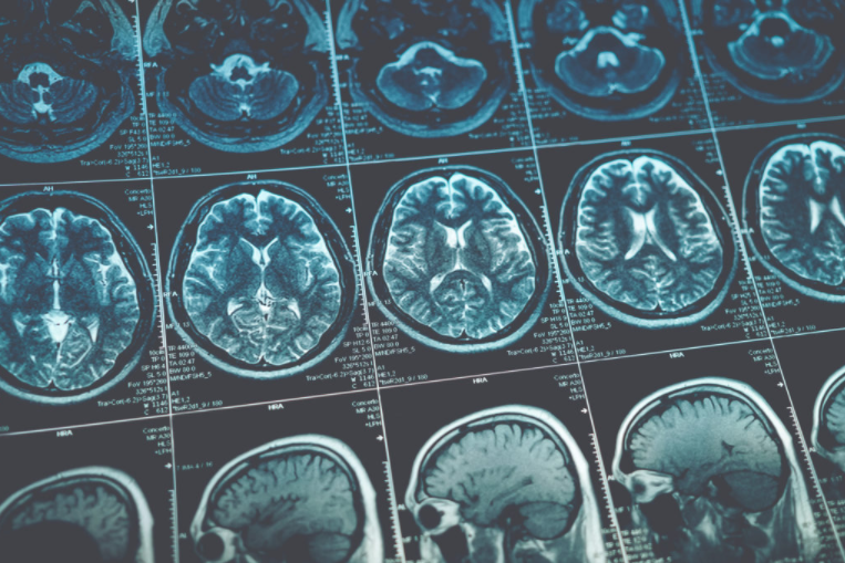 Magnetic resonance images (MRI) of head & brain