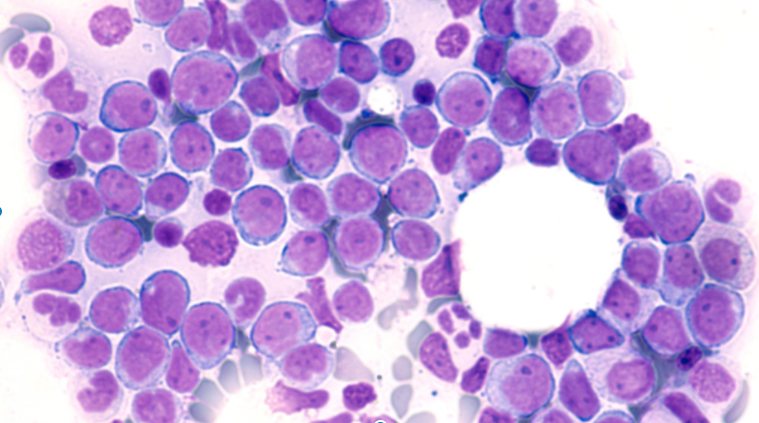 Photomicrograph of bone marrow aspirate showing myeloblasts of acute myeloid leukemia (AML), a cancer of white blood cells.