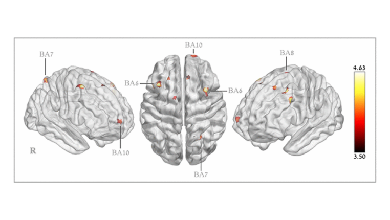 Figure 4. Brain regions with significant post hyperbaric oxygen therapy changes in cerebral blood flow.