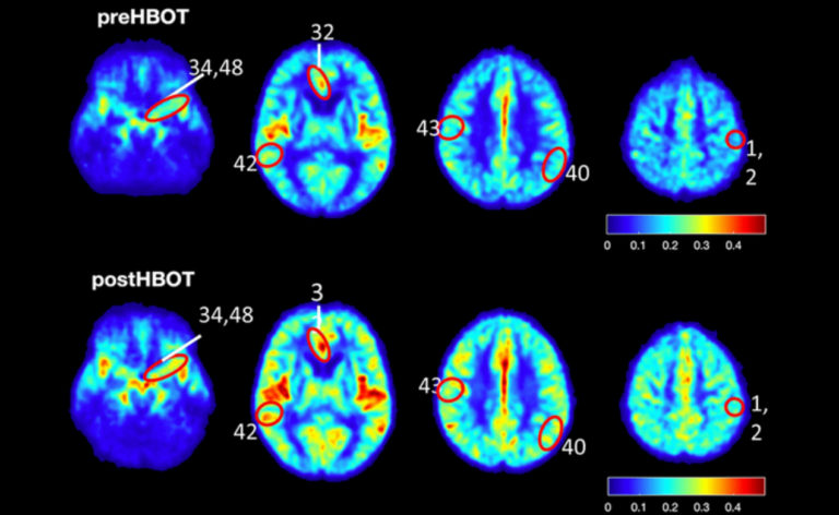 Figure 8. CBF and cognitive function are improved following HBOT of patients.