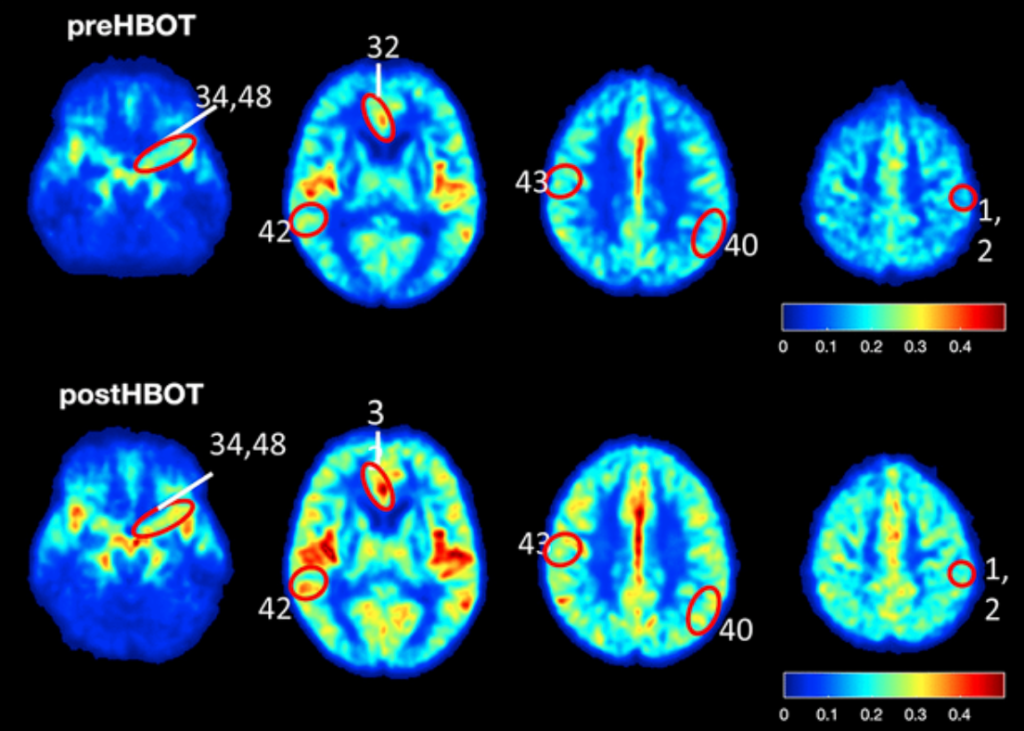 Figure 8. CBF and cognitive function are improved following HBOT of patients.