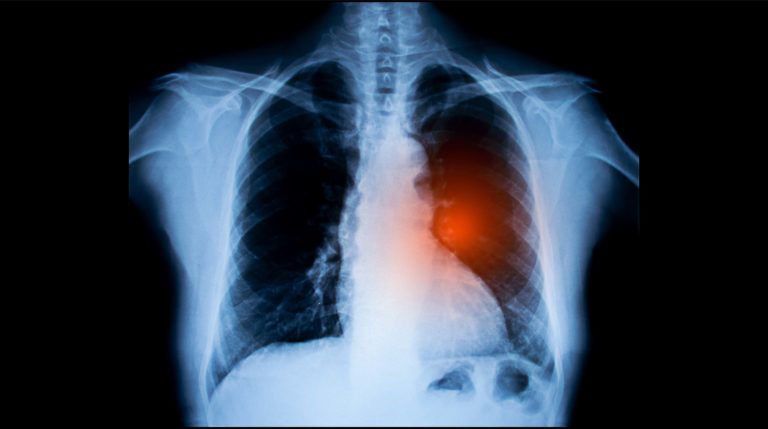 Lung cancer x-ray