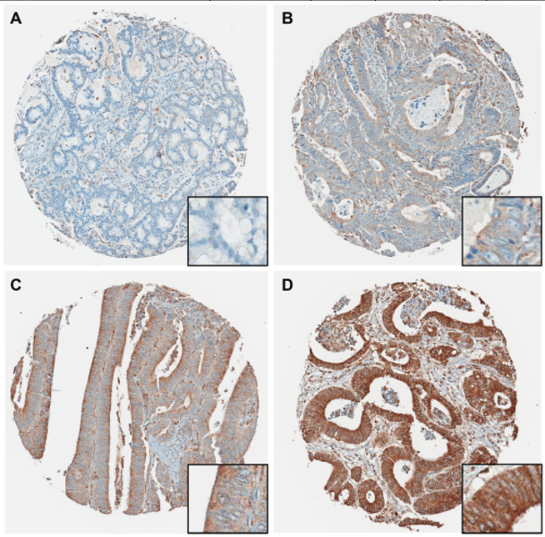 Figure 2: Representative P4HA1 immunohistochemical staining showing four different TMA cores.