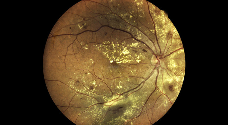 Age-related macular degeneration
