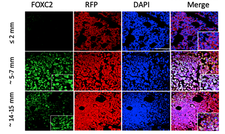 Figure 2: MCF-7 tumor outgrowth is accompanied by increased expression of markers of EMT and hypoxia.