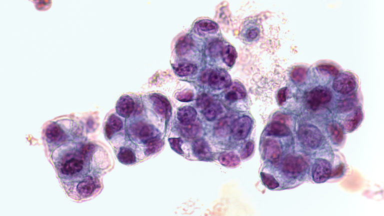 pancreatic ductal adenocarcinoma