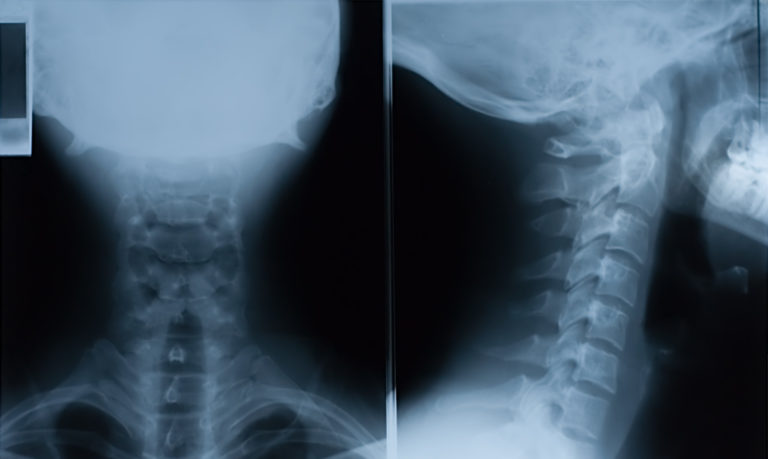 X-Ray film of neck - front and side