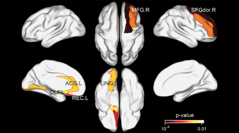 Figure 3. Brain regions exhibiting significant differences in structural nodal efficiency between the tea drinking group and the non-tea drinking group at the significance level of 0.01 (uncorrected) statistical evaluated by a permutation test.