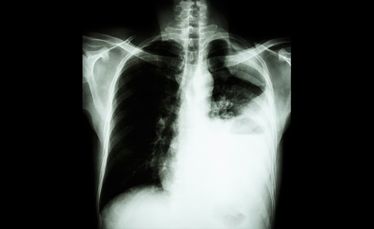 Lung cancer x-ray