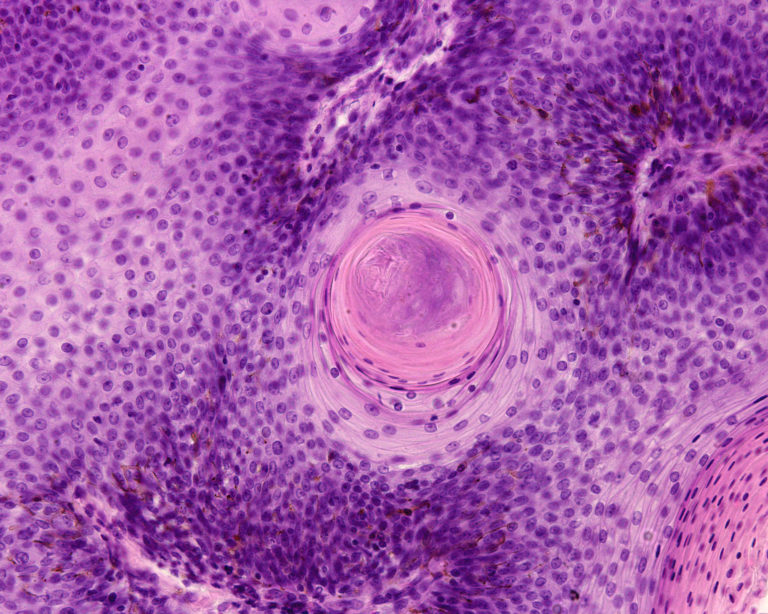 Papilloma of the larynx