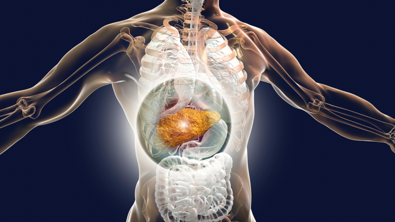 Liver cirrhosis HCC