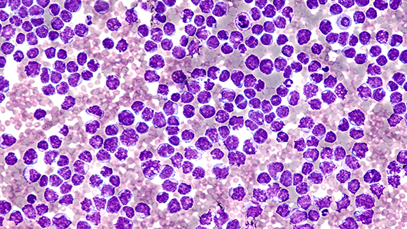 mantle cell lymphoma