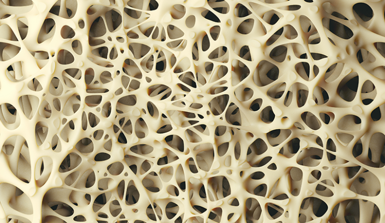 osteoporosis