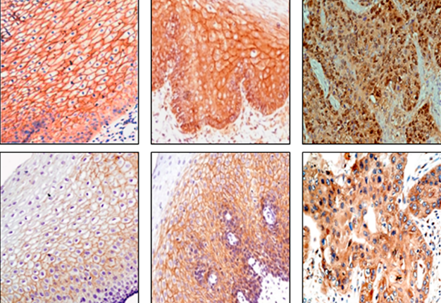 (Rotated & Truncated) Figure 1: Immunohistochemical analysis of Wnt protein in esophageal tissues.