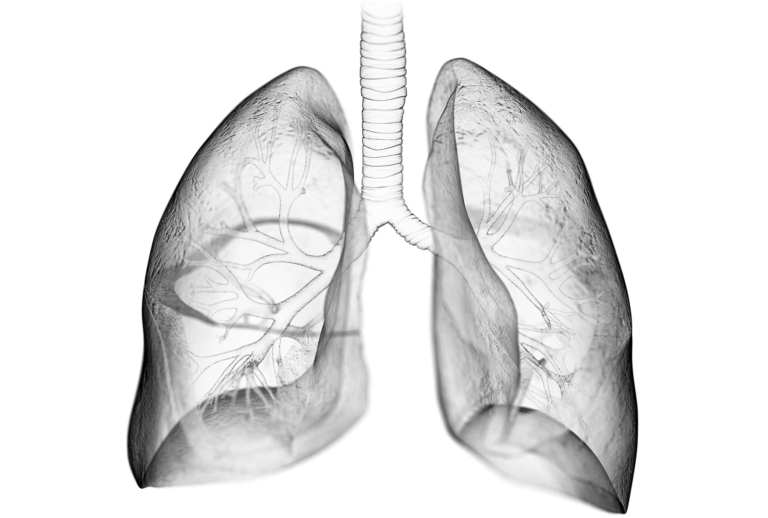 Investigating Susceptibility to Radiation-Induced Pulmonary Fibrosis