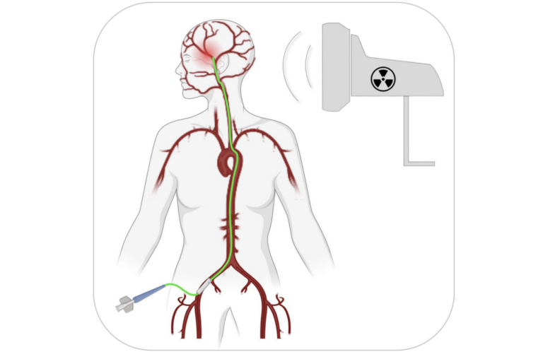 Figure 1: A transfemoral path to BBB opening.