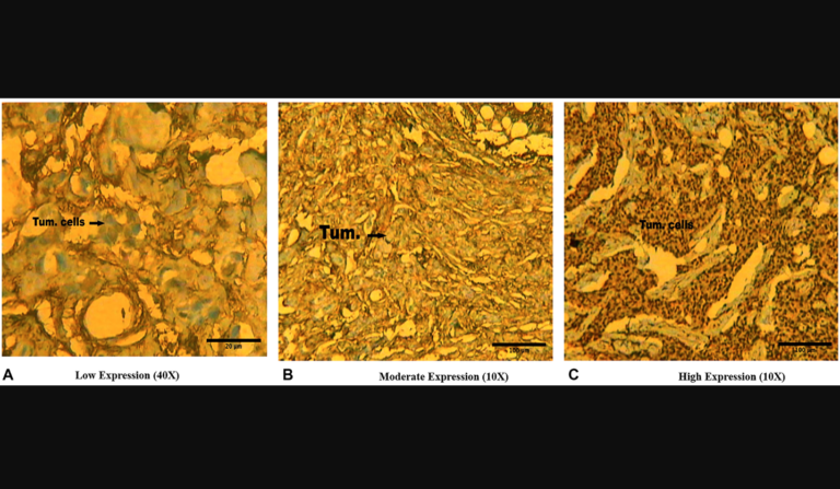 Association of mutation and expression of the brother of the regulator of imprinted sites (BORIS) gene with breast cancer progression