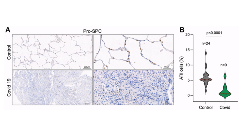 Figure 5. Decreased number of alveolar type II cells in the lungs of COVID-19 patients.