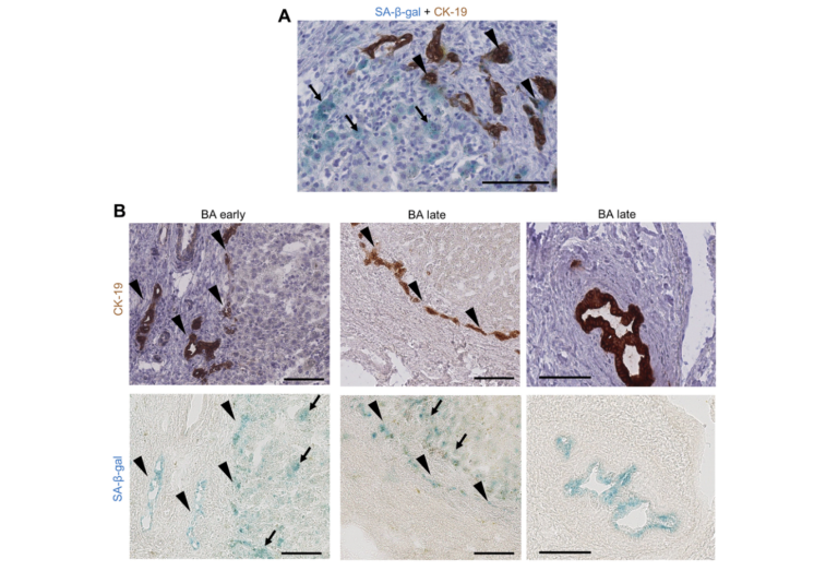 Figure 2. Cholangiocytes and perinodular hepatocytes display cellular senescence in BA livers.