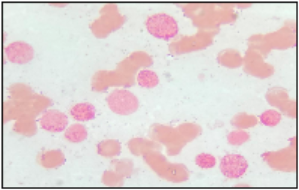 Figure 2: Bone marrow (Peroxydas/Pyronin stain × 100): blast cells strongly peroxydase+.