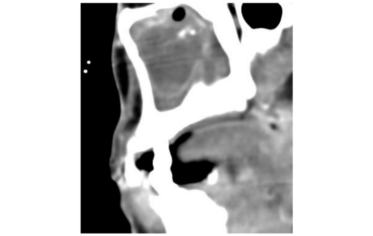 Figure 1: CT-scan in a sagittal section showing a mucosal swelling and obstruction of the maxillary sinus due to an aspergilloma (Contrast medium enhancement). chronic sinusitis