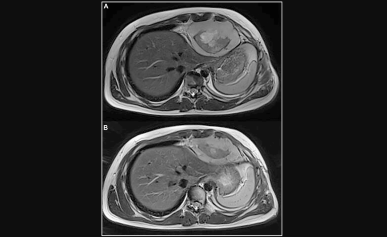 Figure 2: (A) Axial T2 MR shows a heterogeneous mass in the cardiophrenic space with evidence of anterior chest wall invasion and intercostal invasion. (B) Axial T2 MR shows 35 % of reduction in size of the synovial sarcoma mass in the cardiophrenic space.