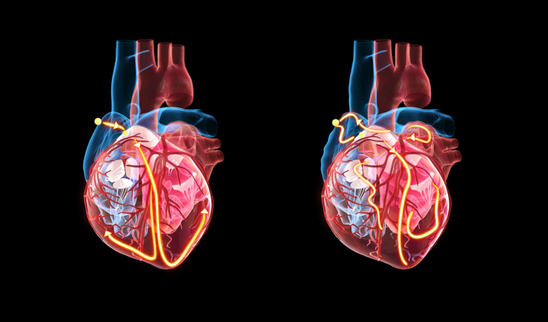 Navigating the Frailty Factor in Atrial Fibrillation Management