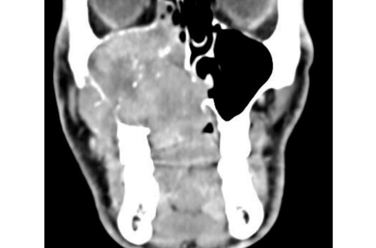 Figure 1: CT-scan in a coronal section showing an adenoid cystic carcinoma as an inhomogeneous mass in the right maxillary sinus with infiltration of neighboring structures.