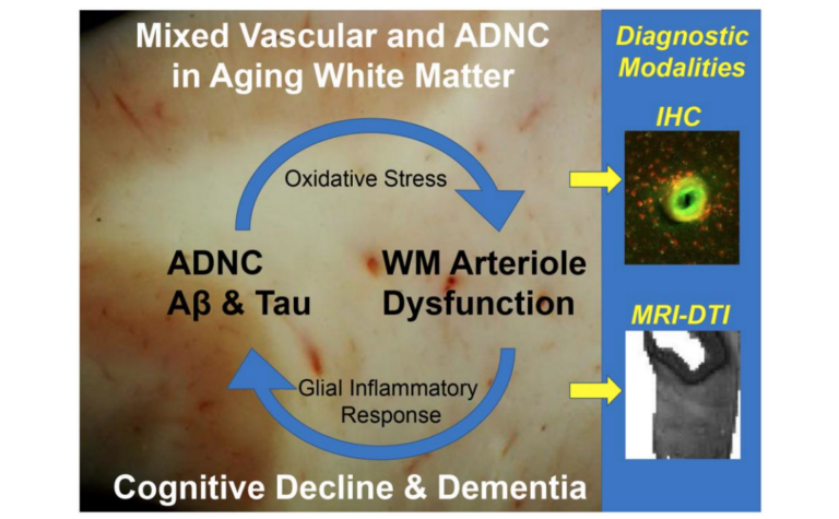 Figure 1. A vicious cycle generating WM injury driven by mixed vascular and ADNC in the aging human white matter.