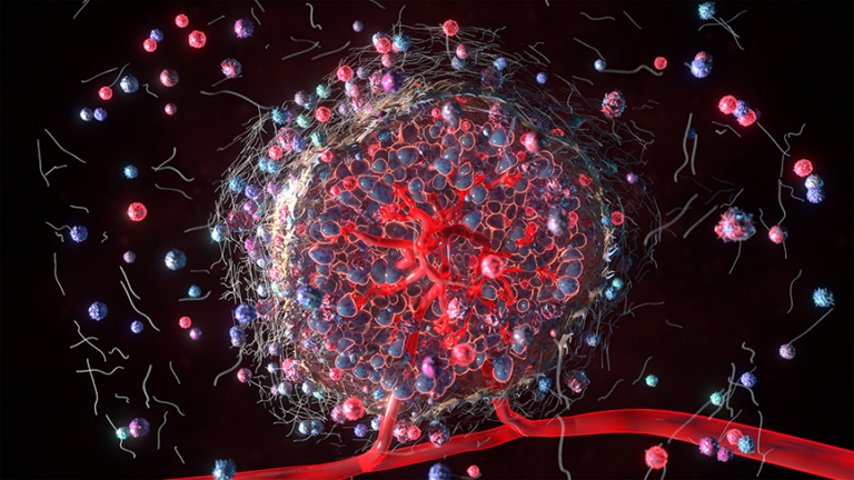 Immunotherapy Response in Primary vs Metastatic Pancreatic Cancer