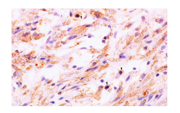 Figure 2. Microscopic image of the expression of the cytoplasmic immunohistochemical reaction to IL-6. A New Connection Between The Gut Microbiota and Prostate Inflammation in Aging Men