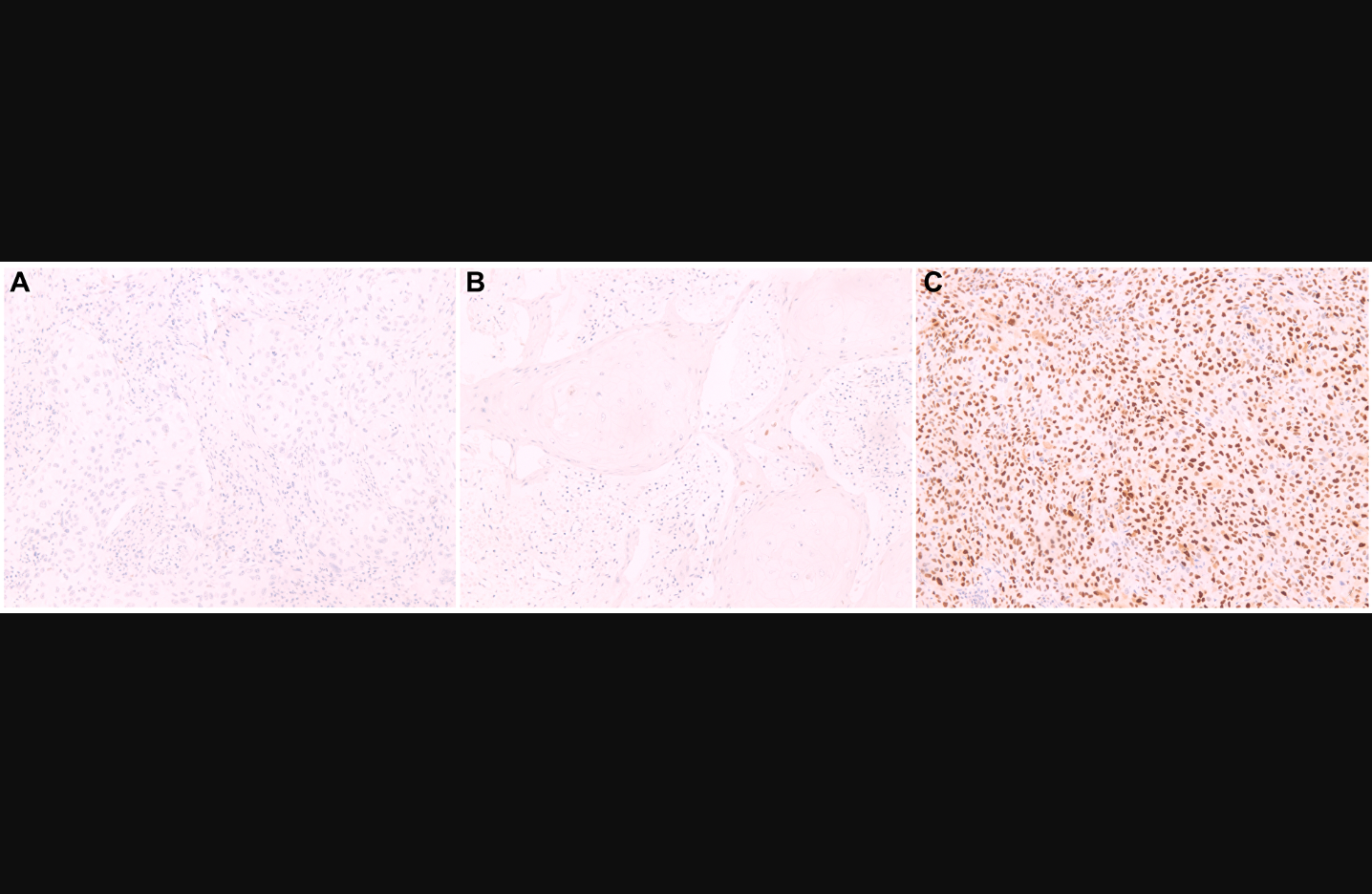 Figure 1: Cyclin D1 protein expression by immunohistochemistry in histological sections.