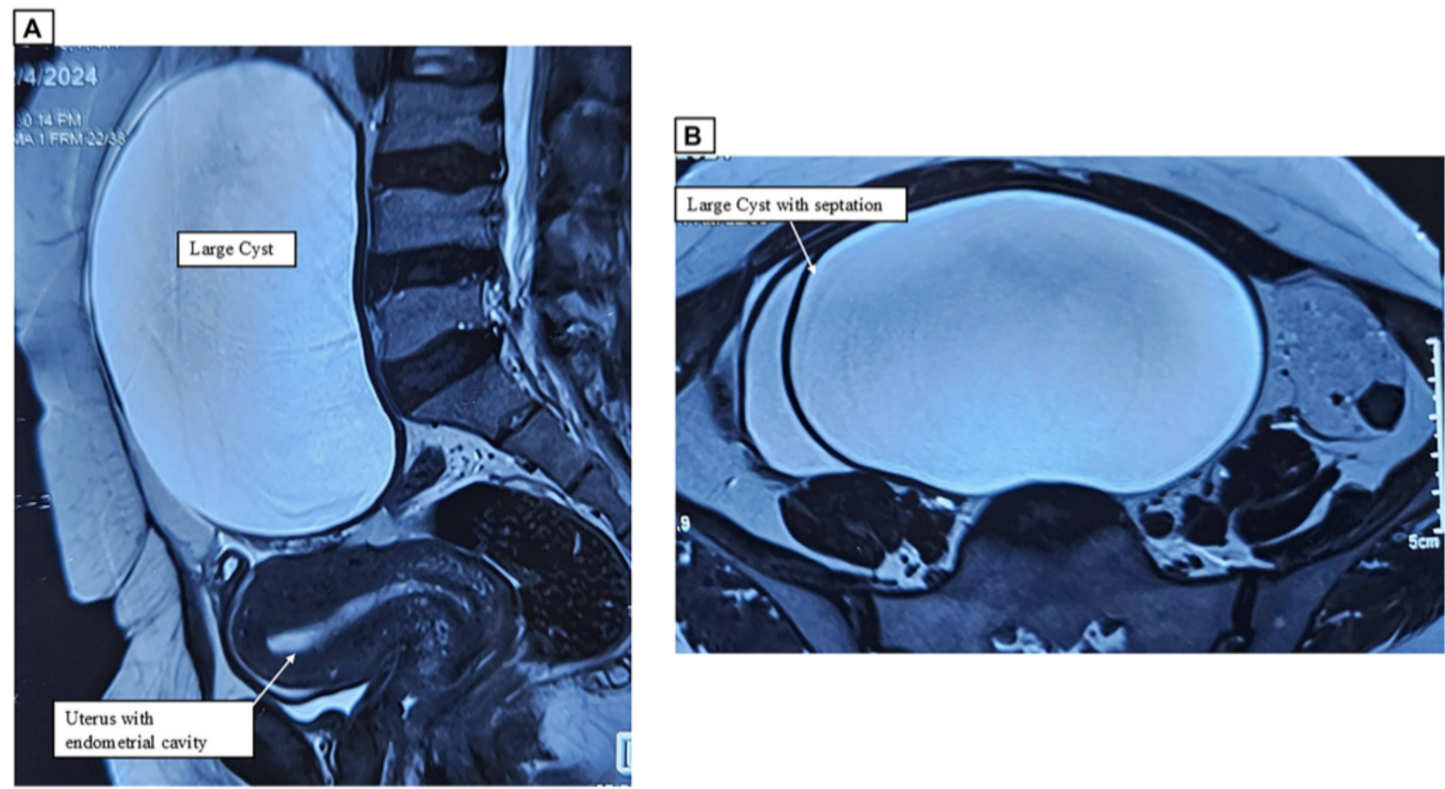 Rare Combination of Ovarian Tumors Found in One Patient