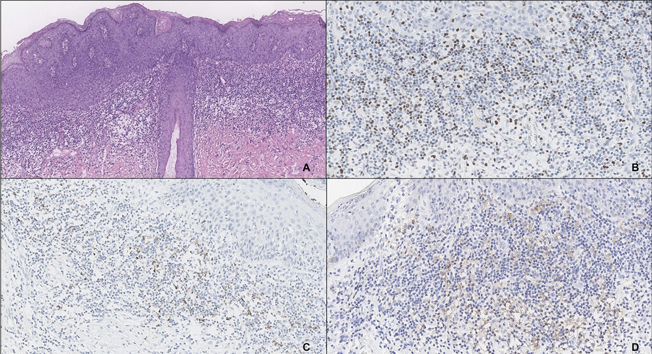 Early Immune Evasion Found in HPV-Related Pre-Cancer Lesions of the Anogenital Region