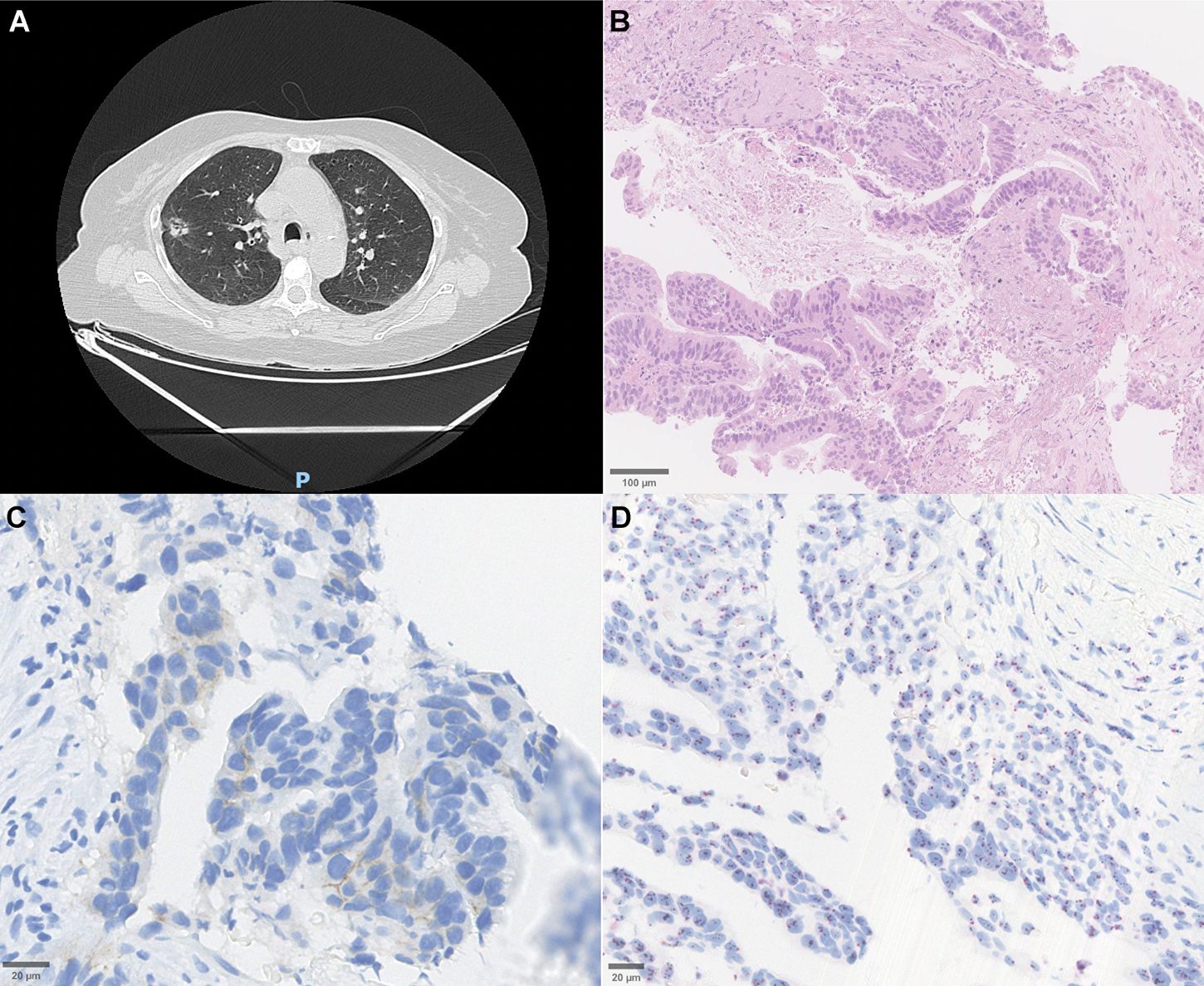 HER2-Mutated NSCLC in Brazil Shows Diverse Genetic Patterns and Treatment Gaps