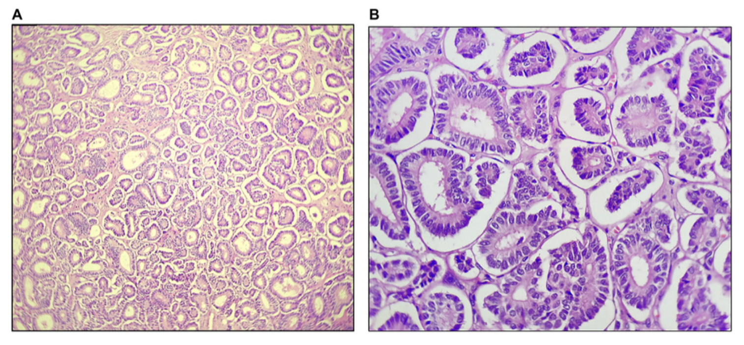 Rare Ovarian Tumor Discovered During Postmenopausal Vault Prolapse Evaluation