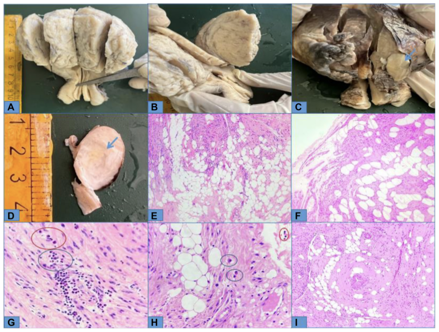 Benign Uterine Tumor Resembling Cancer Highlights Diagnostic Challenges