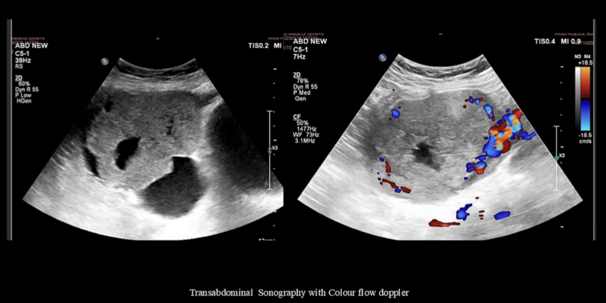 Unusual Case of Rare Ovarian Tumor Mimicking Pregnancy with Successful Treatment Outcome