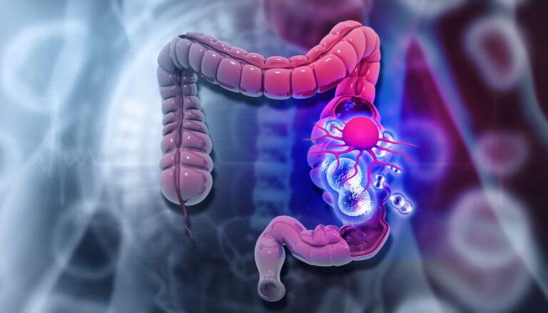 Human colon cancer