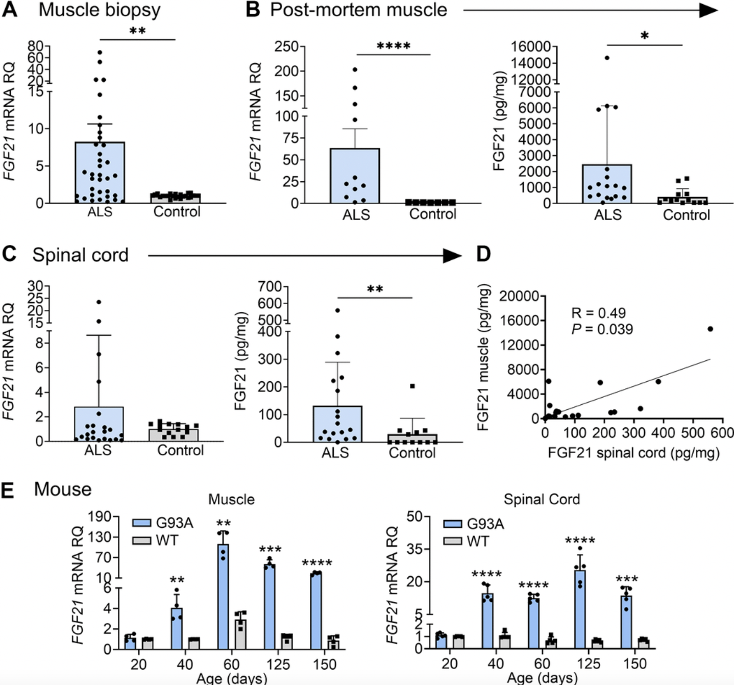 FGF21 Muscle Hormone Associated with Slow ALS Progression and Extended Survival