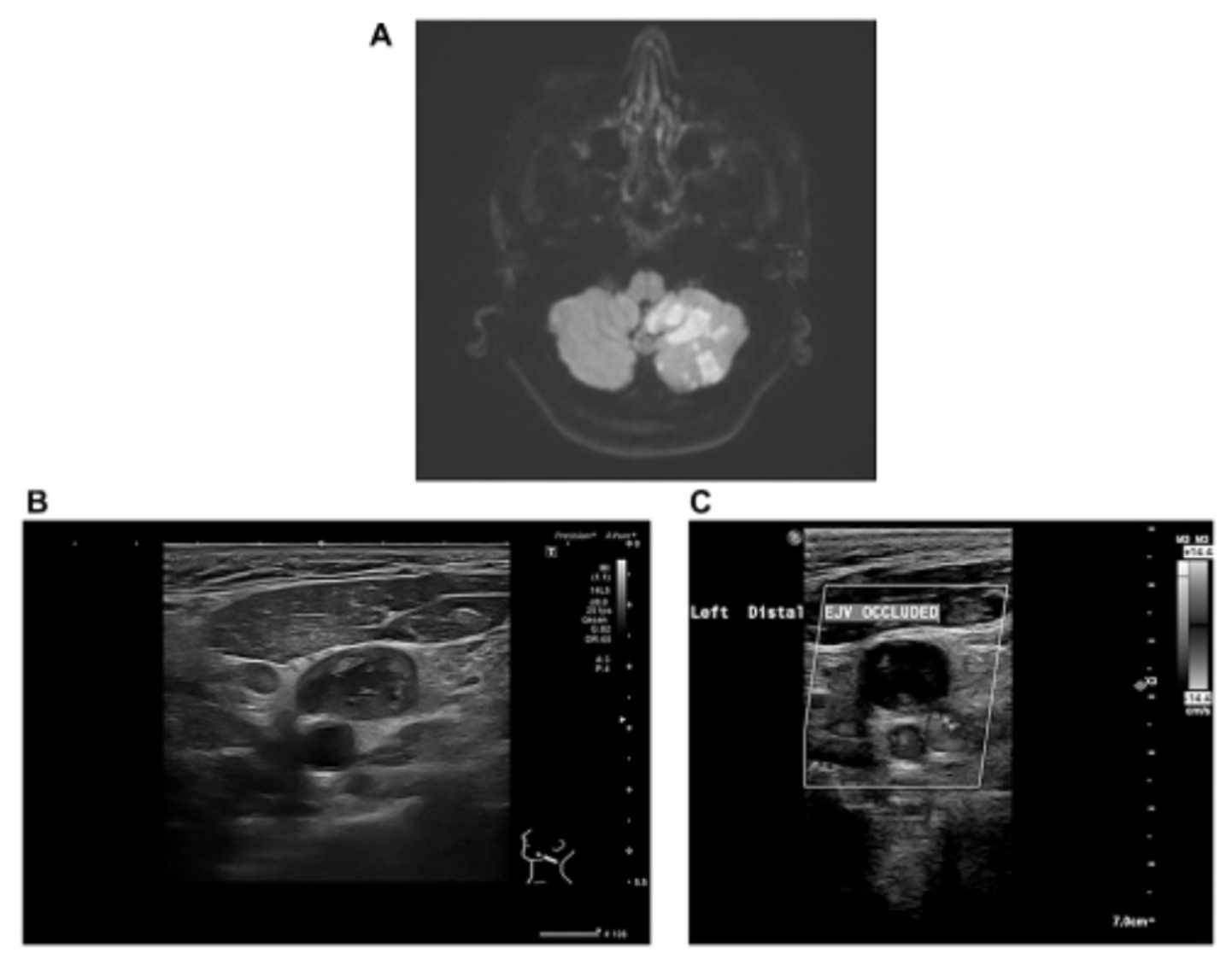 Multiple Strokes Lead to Hidden Colorectal Cancer Diagnosis in Rare Case