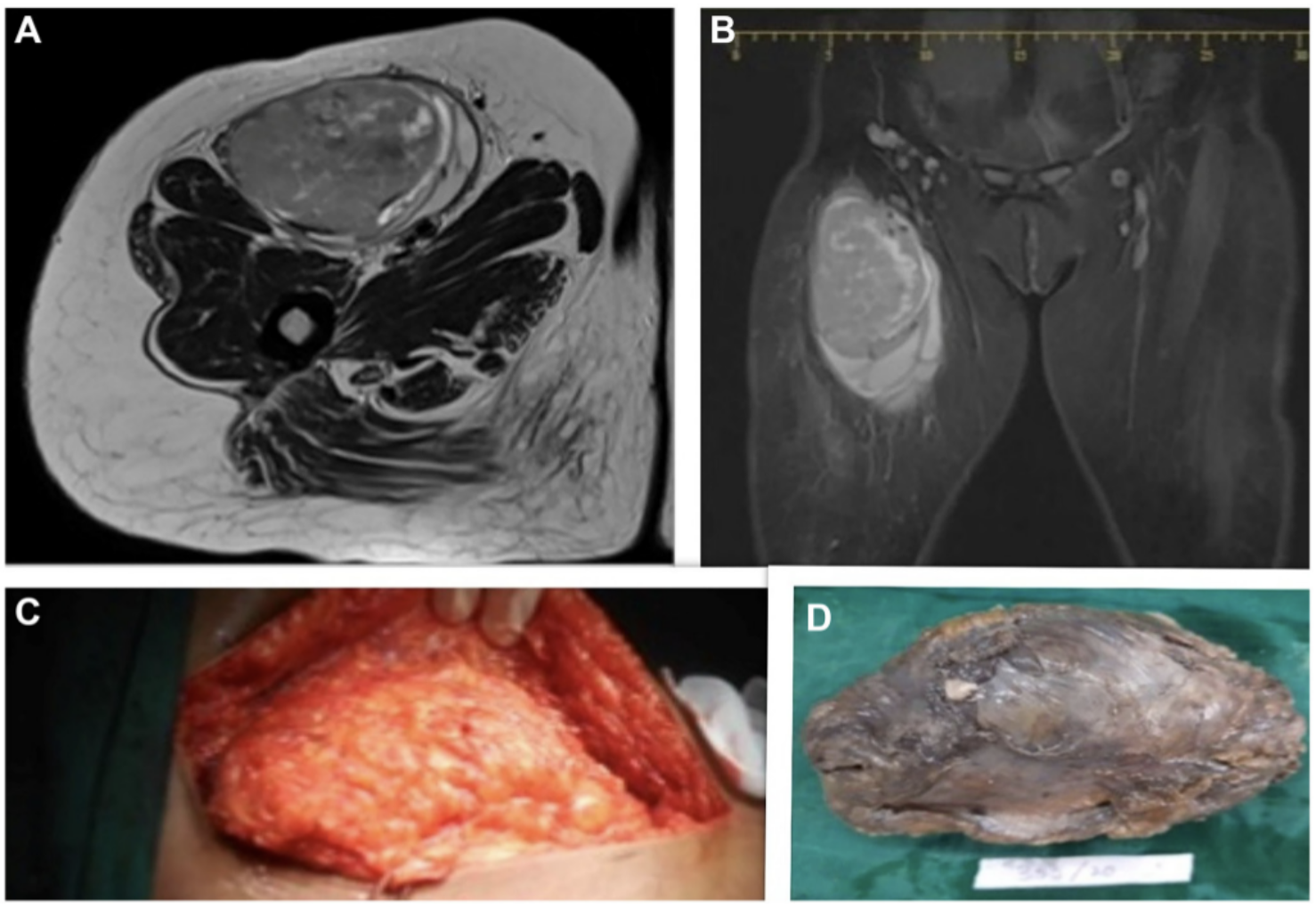 Adult Fibrosarcoma Case Report Shows Importance of Early Diagnosis and Targeted Therapy