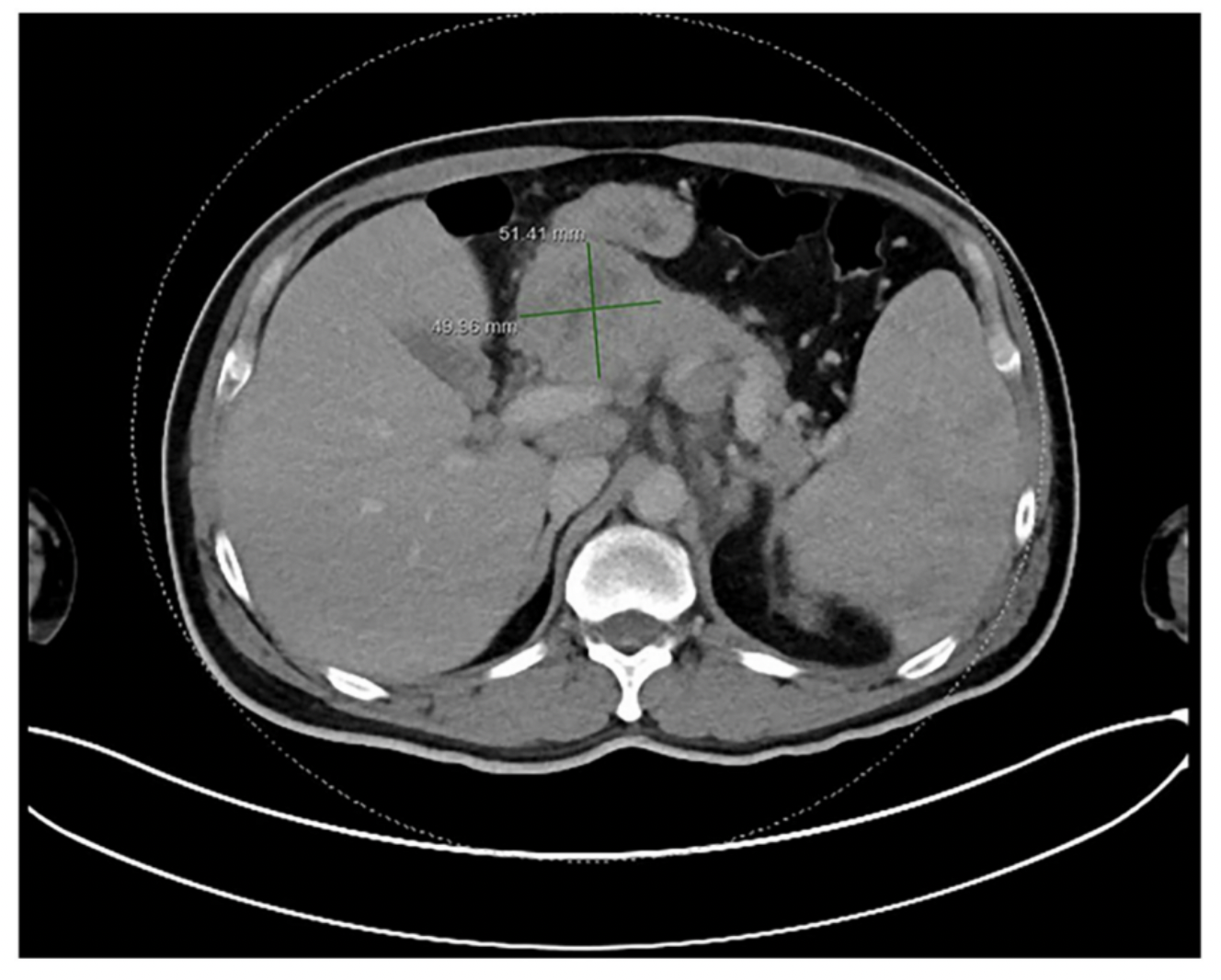Rare Case of Pancreatic Hodgkin Lymphoma Highlights Importance of Early Diagnosis