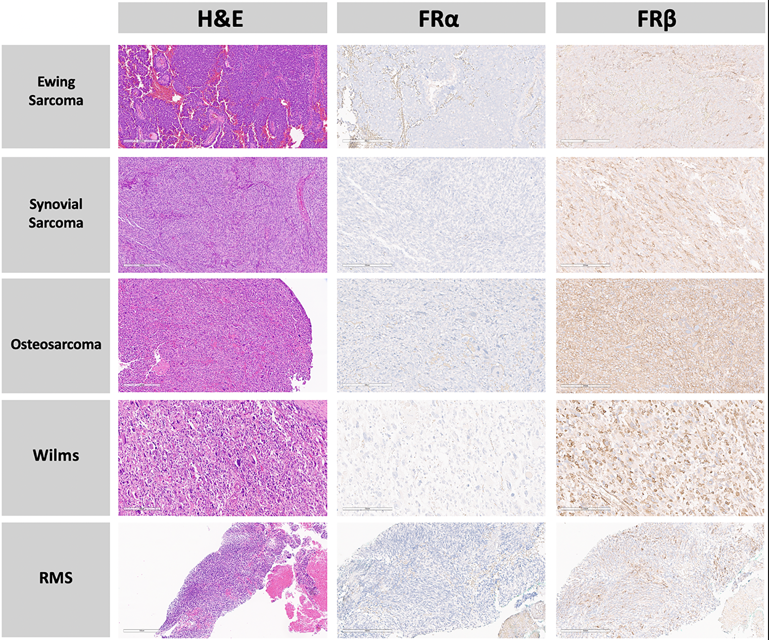Folate Receptor Beta Found in Pediatric Tumors May Improve Fluorescence-Guided Cancer Surgery