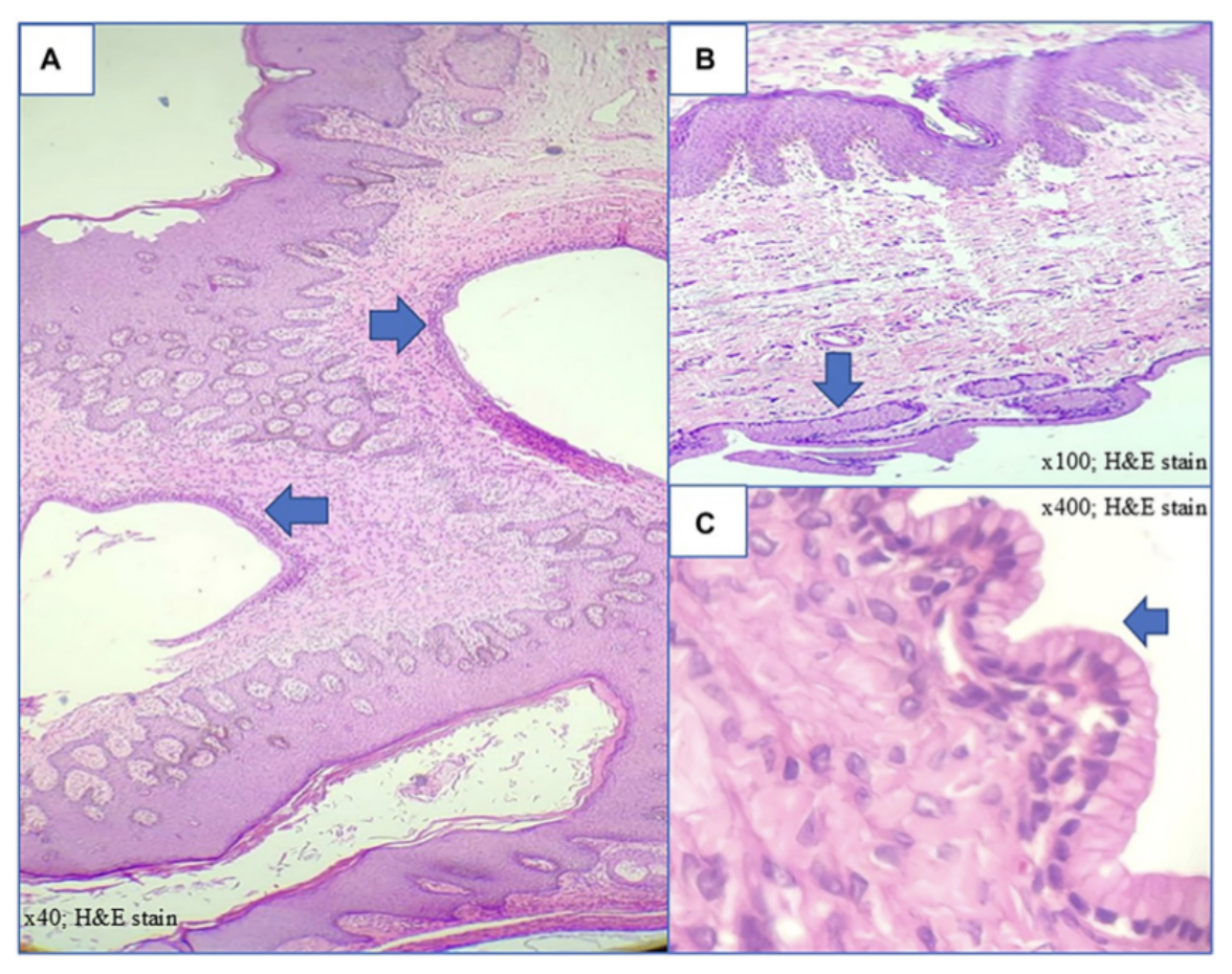 Rare Vulvar Cyst Case Report Sheds Light on Diagnostic Challenges