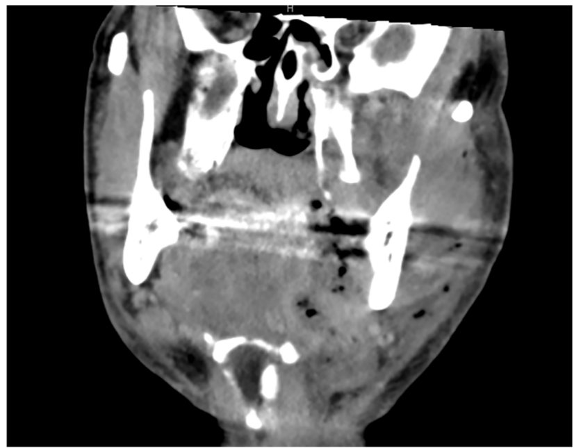 Early Recognition and Surgical Management Key in Necrotizing Fasciitis of the Head and Neck