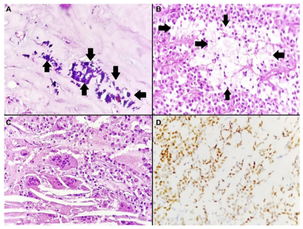 Rare Pancreatic Tumor Case Suggests Distinctive Calcification Patterns in Solid Pseudopapillary Neoplasms