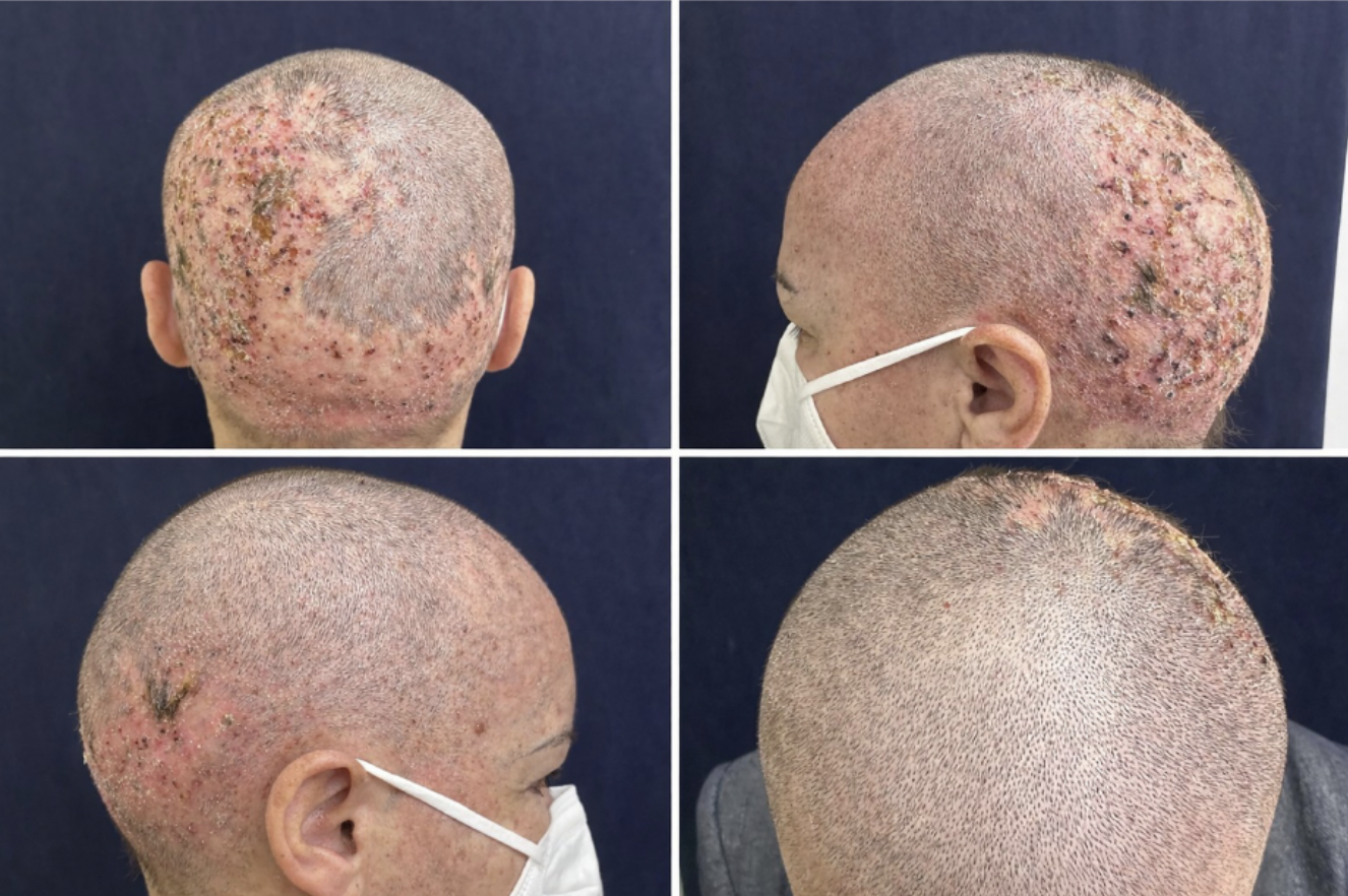 Rare Scalp Reaction Identified in Lung Cancer Patient Receiving Amivantamab After Radiotherapy