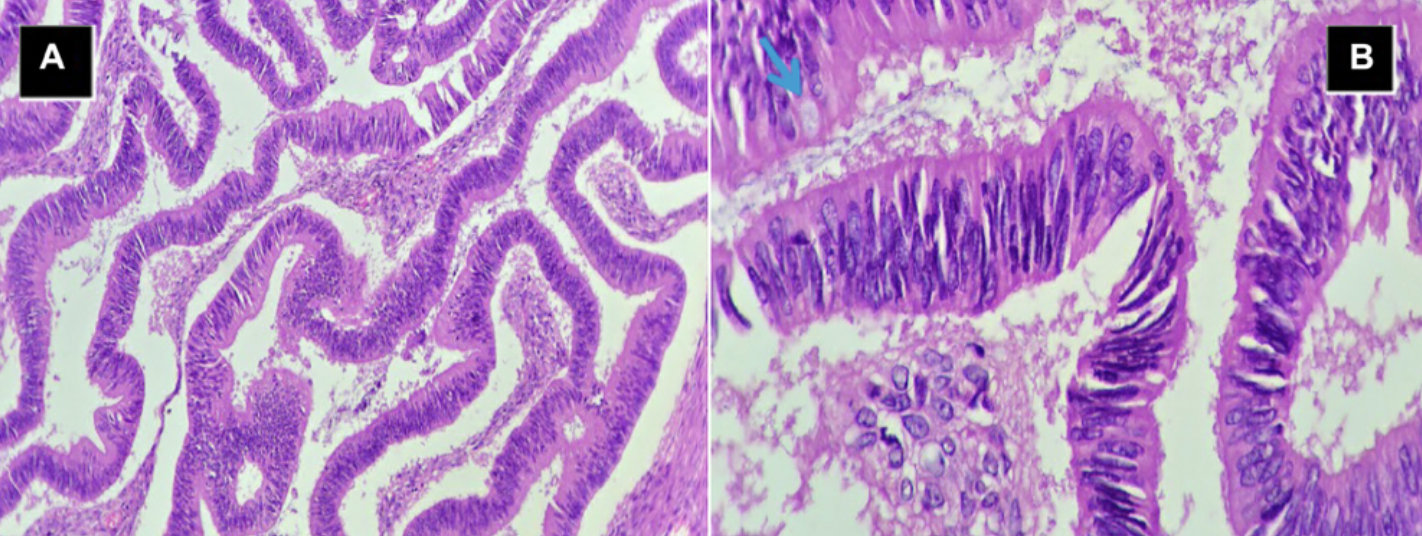 Deceptive Ovarian Cancer Case Mimics Pelvic Abscess, Delaying Diagnosis in Postmenopausal Woman